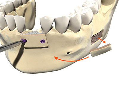 Colocación de un tornillo de la gama Graftek en la mandíbula
