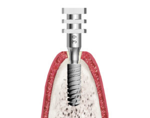 Implants In-Kone® plateforme NR (3.0)_Coupe d'un transfert Pick-up sur site