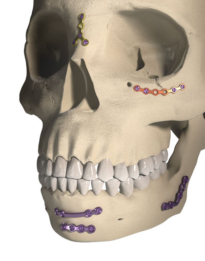 Posizionamento su cranio di placche per traumatologia Ortrautek