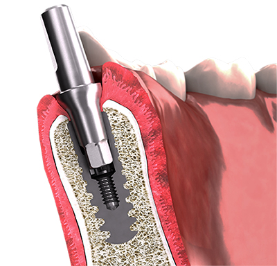 Przekrój łącznika dla implantu 3.0 po założeniu na miejsce