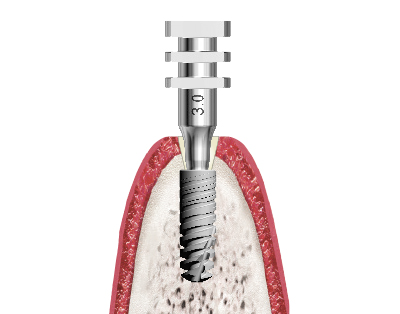 Section of a 3.0 Implant prosthetic impression coping on-site installed directly in the mouth in its 3.0 implant