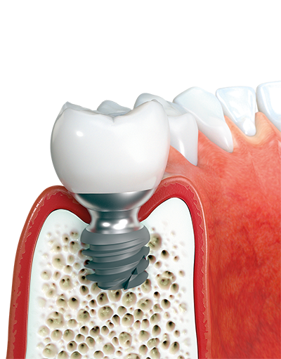 Système Implantaire twinKon®4 coupe Global D mini-implant 4mm