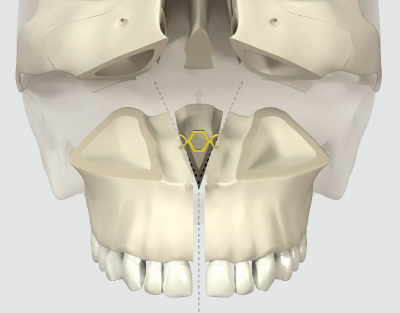 Ortrautek maxillary plate on the skull