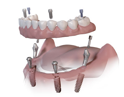 Vue d'une restauration complète sur 4 implants en mise en charge immédiate