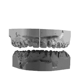 Vue frontale d'une occlusion intermédiaire