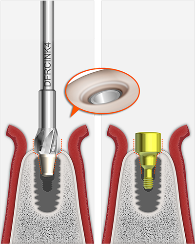 Insertion of a ULTIMATE cortical cutter