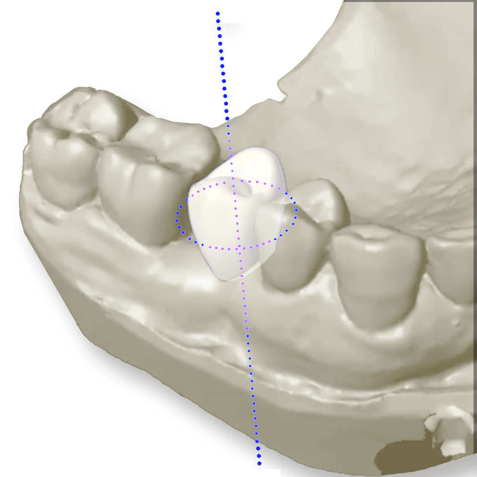 Logiciel de planification pour Chirurgie Guidée & Pilotée