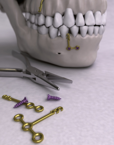 Ancotek Orthodontic Ancorage Plates, Ancorage Mini-Screws and Jaws