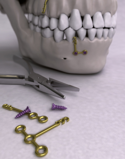 Les mini-vis orthodontiques