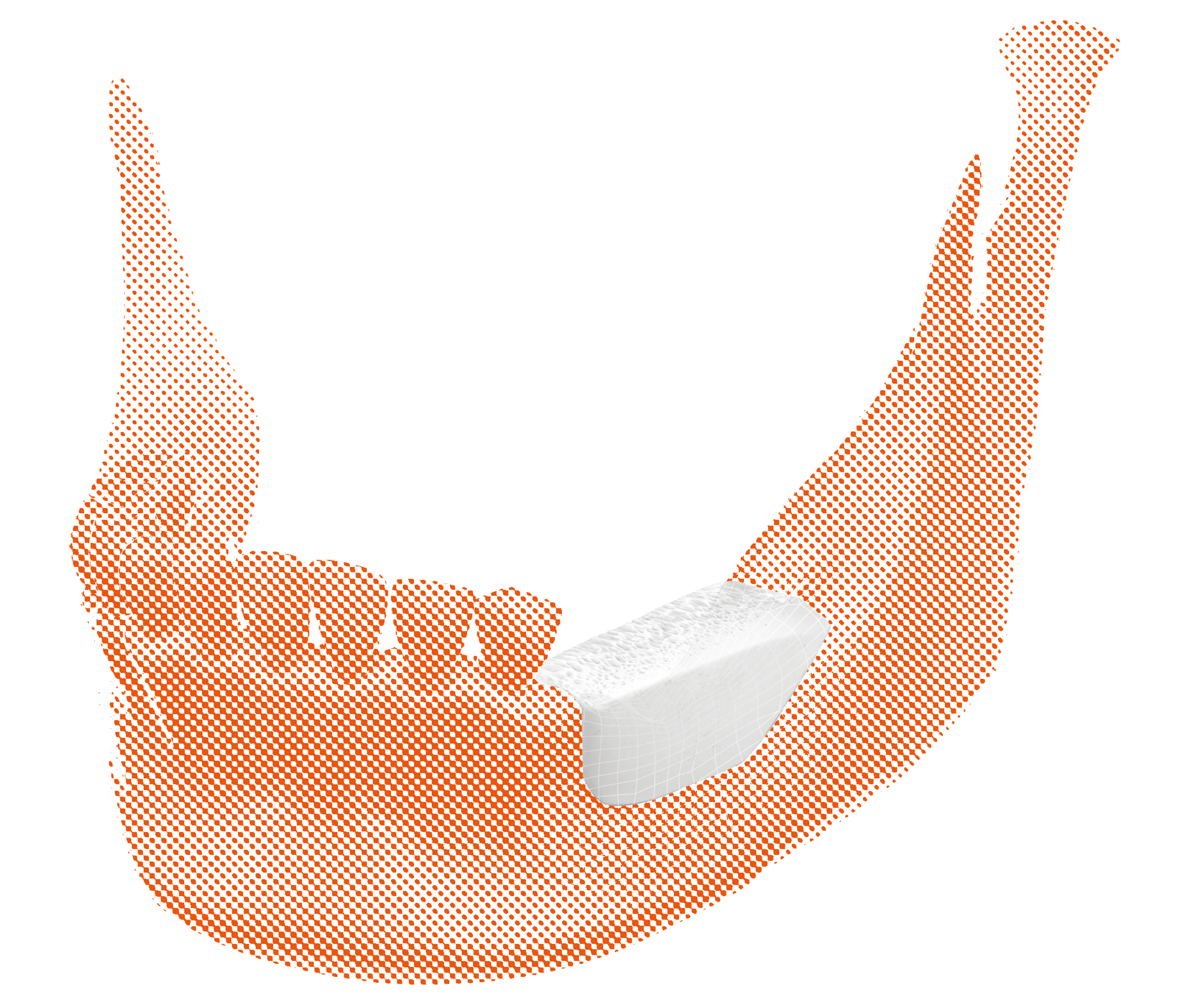 BIOBank customized graft mounted on the posterior sector of the mandible