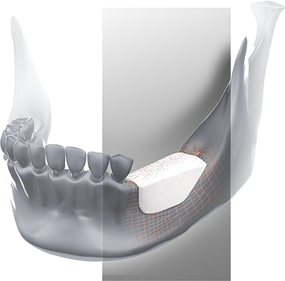 BIOBank customized graft mounted on the posterior sector of the mandible