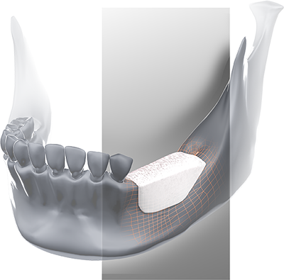 Injerto a medida BIOBank colocado en sector posterior mandibular