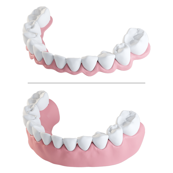 Prothèse Fixe Complète Mandibulaire - Secteurs Atrophiés