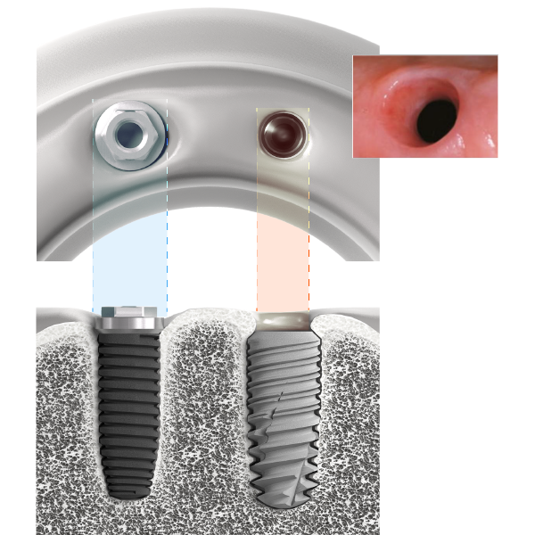 Temas clínicos_Implantología estética_La implantología Bone Level revisada