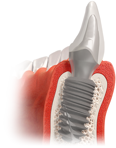 Product Conept_In-Kone®, Revised Bone Level Implantology