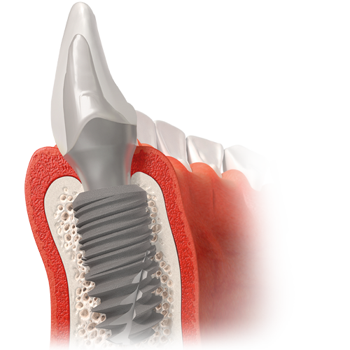 Clinical Experiences_In-Kone® Alveolar Bone and Mucosa