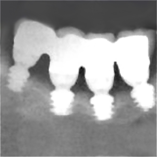 Clinical Experiences_Atrophied Sectors_twinKon®4 Scan Implants