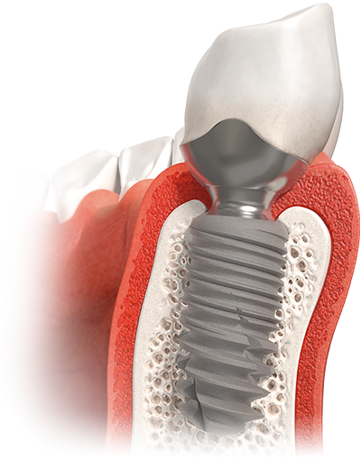 twinKon®, Implantologie Tissue Level revisitée