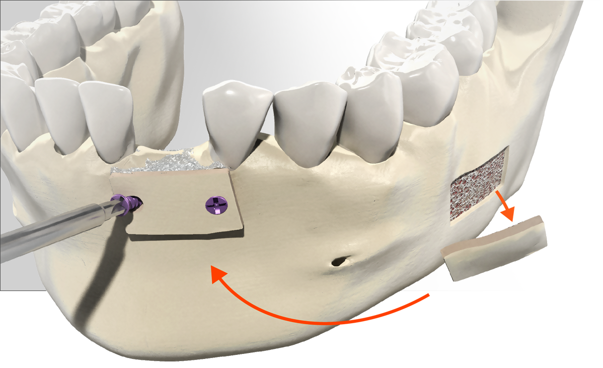 Blocco osseo prelevato in zona retromolare e posizionato nel settore mandibolare anteriore 
