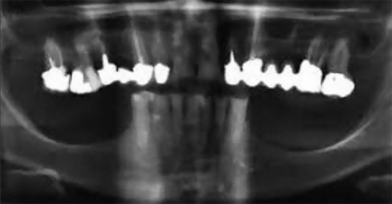 Clinical Experiences_Atrophied Sectors_Posterior Mandibular Scan