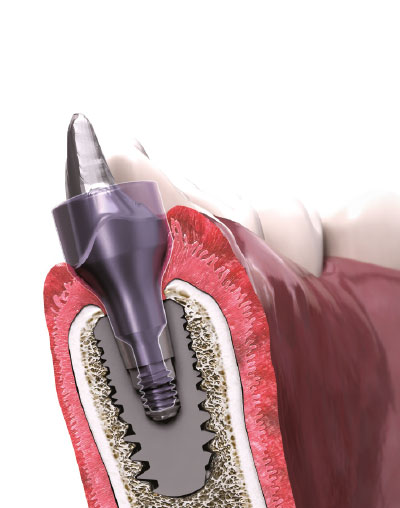 Vis de Cicatrisation & Faux-moignon sur secteur molaire - In-Kone® Plateforme WD