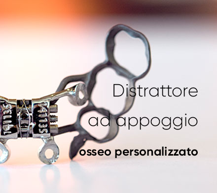 Focus su_Distrattore Ad Appoggio Osseo Personalizzato