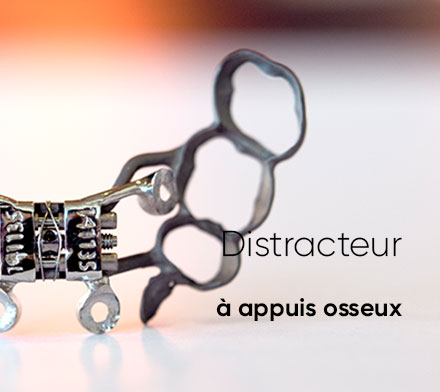Focus Sur_Distracteur A Appuis Osseux