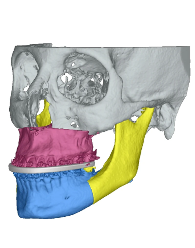 Logiciel de planification en chirurgie orthognathique Romexis