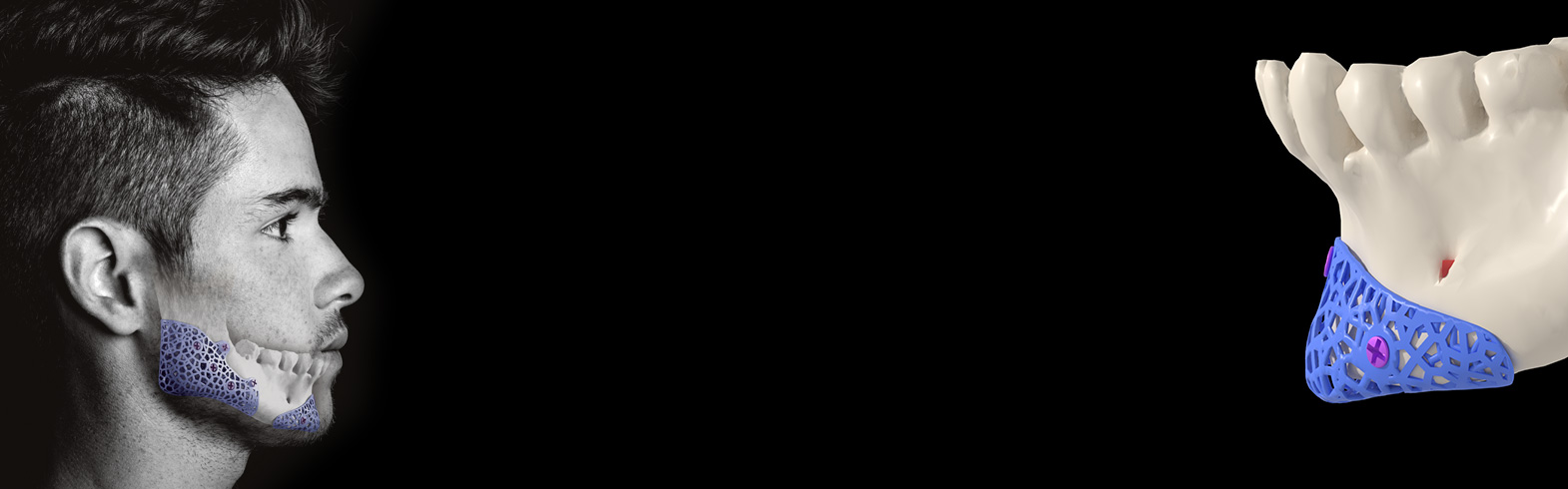 Prothese symphysaire sur-mesure Global&nbsp;D