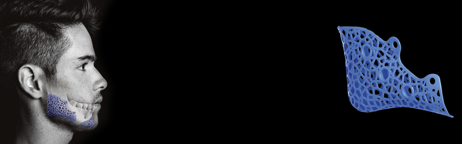 Prothèses d’angles mandibulaires sur-mesure Global&nbsp;D