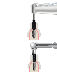 Pose Cles Porte-implants G42-G52 Contre-Angle manuelle